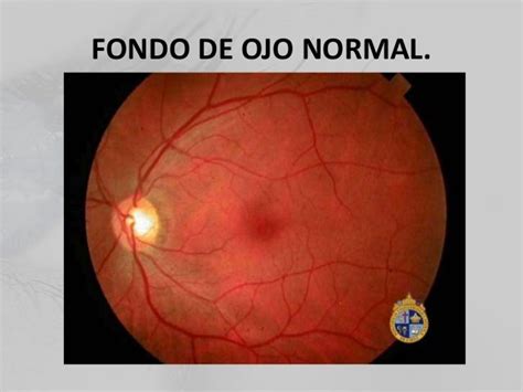 Retina Oftalmología.