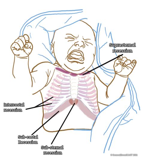 Paediatrics: Bronchiolitis — General BroadCAST