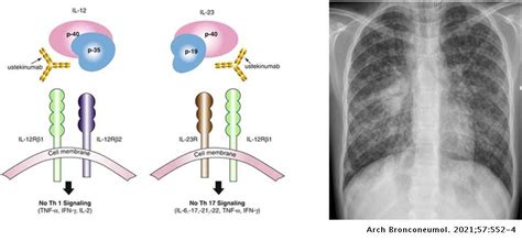 A Case of Disseminated Tuberculosis in a Child with Crohn's Disease After Treatment with ...