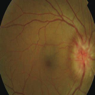 At the time of diagnosis, right eye demonstrates severe papillary edema... | Download Scientific ...