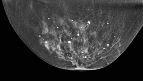 Mammographic Microcalcifications and Risk of Breast Cancer | Cancer Community