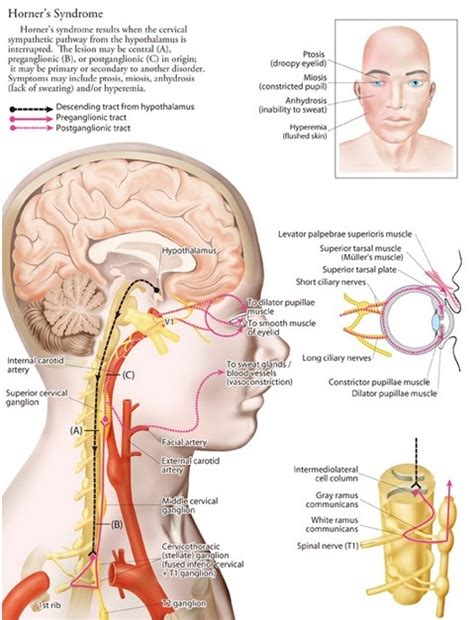 Superior Cervical Ganglion Syndrome Treatment - Captions Hunter