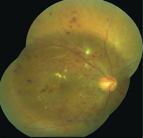 Case study: Patient presents with severe PDR history