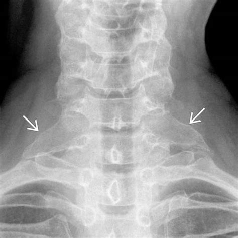 Normal Variant | Radiology Key