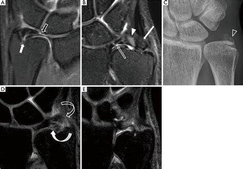 Tfcc Tear Mri - Goimages Inc