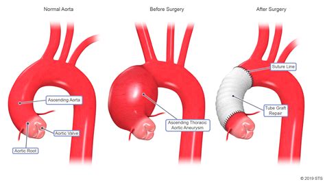 Thoracic Aortic Aneurysm - Newport Cardiac & Thoracic Surgery