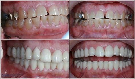 Full Mouth Reconstruction: Top 12 Questions To Ask Before Getting It