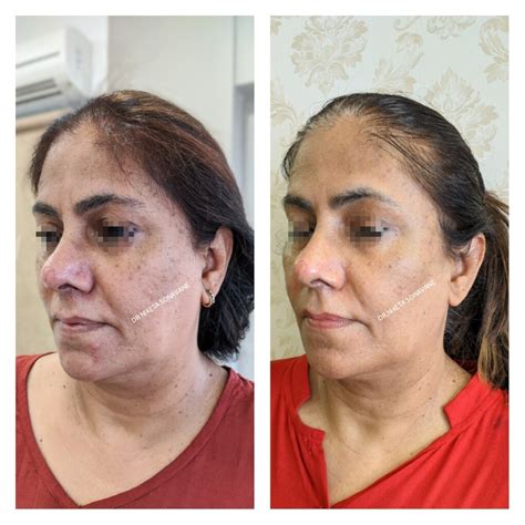 Skin Tightening Treatment in Mumbai - Cost, Before After, Procedures