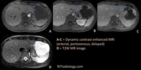 RiT radiology: Hepatic Hemangioma: MR Findings