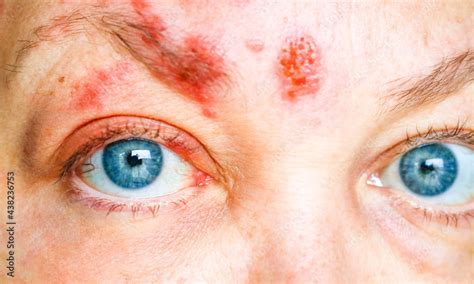 Shingles on the Face and Around the Eye of a Woman, Called ophthalmic herpes zoster or herpes ...