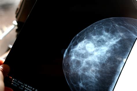 More Mammograms May Not Always Mean Fewer Cancer Deaths : Shots - Health News : NPR