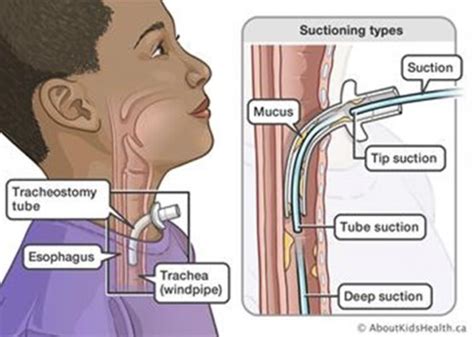 HINT: What is the correct catheter size when suctioning a tracheostomy? — Connected Care @ SickKids