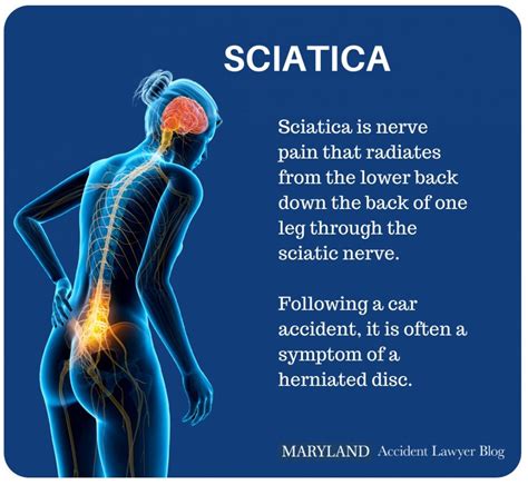 Sciatica Pain After a Car Accident — Maryland Accident Lawyer Blog