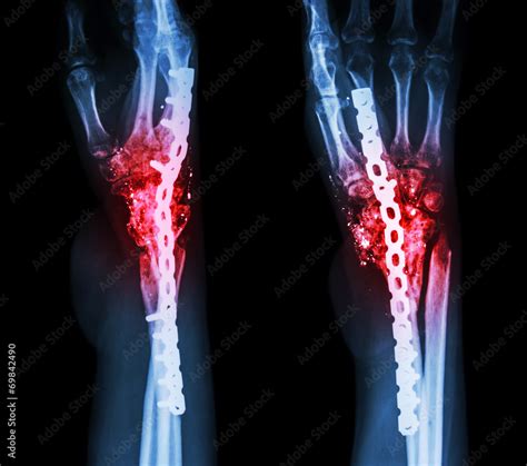 Fracture wrist and chronic infection.operated, internal fixed Stock Photo | Adobe Stock