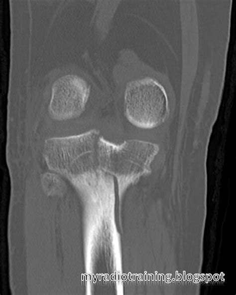 Radiology info hub: Proximal tibial fracture - Schatzker Classification