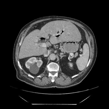 Cholecystoduodenal fistula | Image | Radiopaedia.org