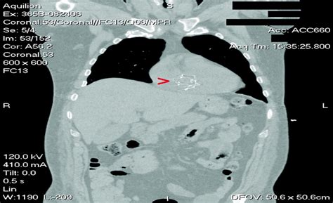 Inferior Vena Cava Filter Migration to Right Ventricle With... : Journal of Trauma and Acute ...