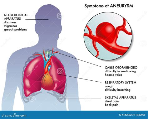 Aneurysm Symptoms Stock Photo - Image: 44425625