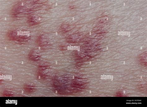 Rash on human skin due to chiggers, Family Trombiculidae Stock Photo - Alamy