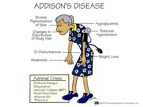 Understanding Addison's Disease | Faculty of Medicine