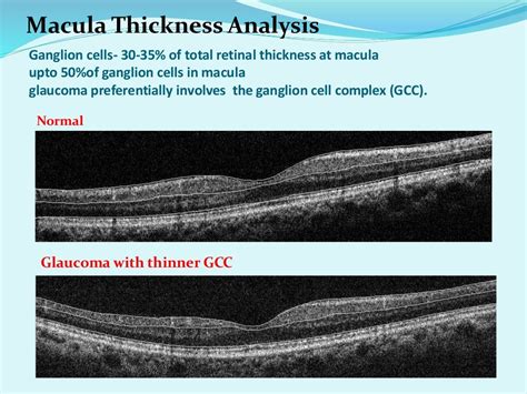 Oct in glaucoma