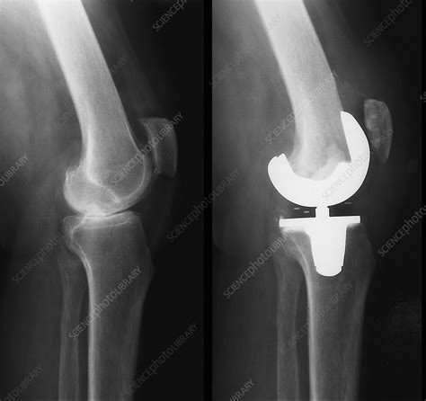 Before and after a total knee replacement, X-ray - Stock Image - C053 ...