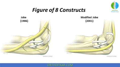 Elbow UCL Repair Surgery | OrthoFixar 2024