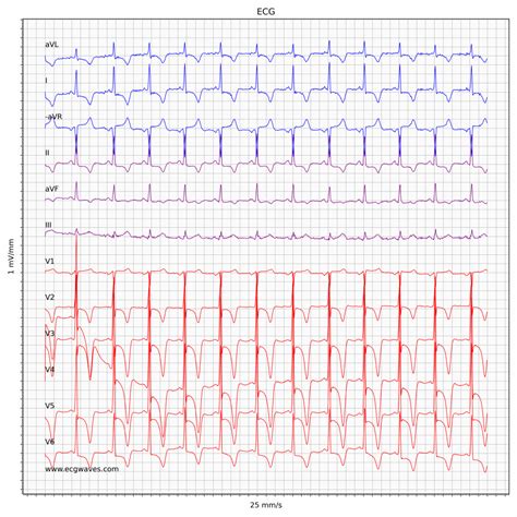 Hypertrophic Cardiomyopathy (HCM) & Hypertrophic Obstructive Cardiomyopathy (HOCM ...