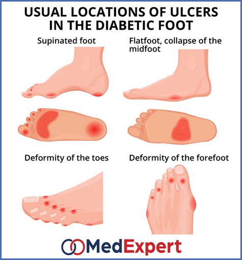 Treatment For Numbness In Feet Due To Diabetes - Numbness of legs ...