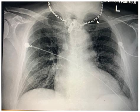 Chest X-ray AP view showing bibasilar opacities likely atelectasis and... | Download Scientific ...