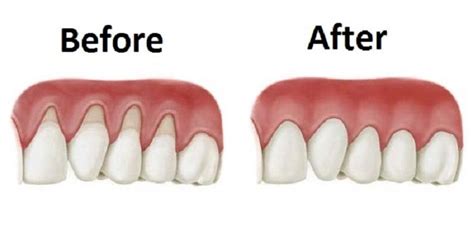 How to Reverse Periodontal Disease | Gum health, Grow back receding gums, Teeth health