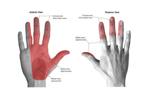 Carpal tunnel syndrome | Physiotherapy Manly