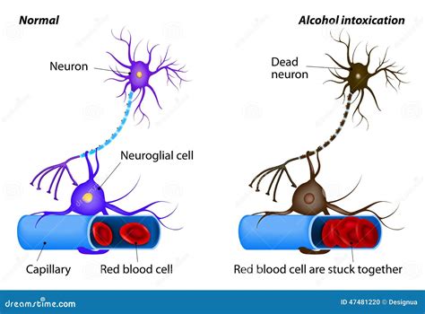 Nerve Damage Caused By Heavy Alcohol Intoxication Stock Vector - Image: 47481220