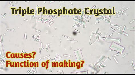 Triple phosphate crystals in urine | Crystals in urine microscopy - YouTube