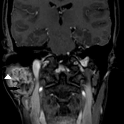 T2 axial MRI taken at the level of the stylomastoid foramen shows the ...