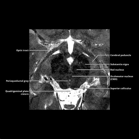 Inferior Colliculus Mri