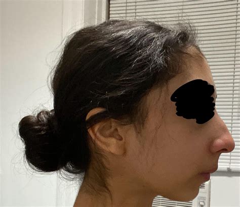 Please help! What would improve my side profile? Rhinoplasty + genioplasty? : r/PlasticSurgery