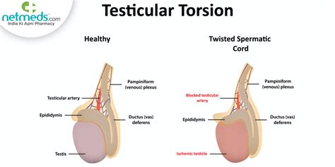 Testicular Torsion: Causes, Symptoms, Diagnosis Treatment, 47% OFF