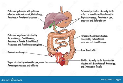 Peritonitis Cartoons, Illustrations & Vector Stock Images - 911 ...