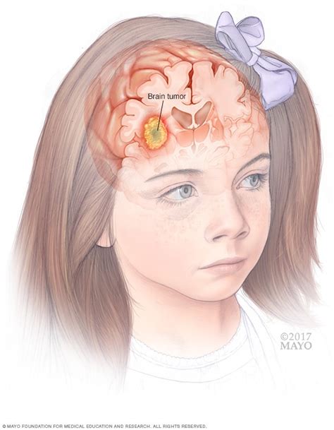 Tumores cerebrales pediátricos - Síntomas y causas - Mayo Clinic