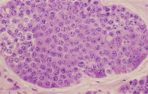 lung carcinoid