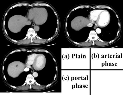 The contrast-enhanced computed tomography scan obtained approximately... | Download Scientific ...