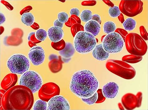 Blood cancer-Types,Symptoms,Causes,Risk factors,Diagnosis