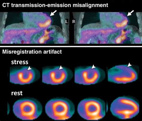 STRESS MYOCARDIAL PERFUSION SCAN :- HAUZ KHAS 099