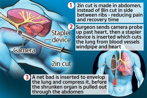 NHS medics become first in world to remove cancer patient’s lung using special keyhole surgery ...