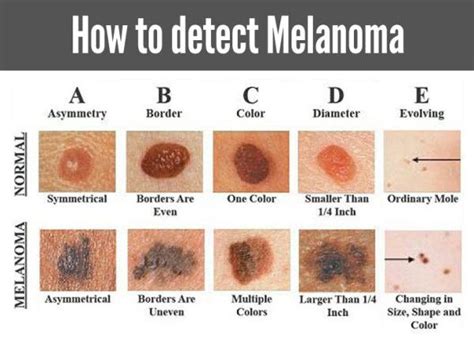 How To Tell The Difference Between A Mole And Cancer - CancerWalls