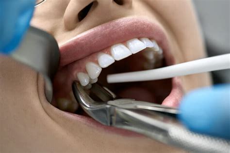 Affordable Tooth Extraction Houston | Teeth Extraction Cost 2020