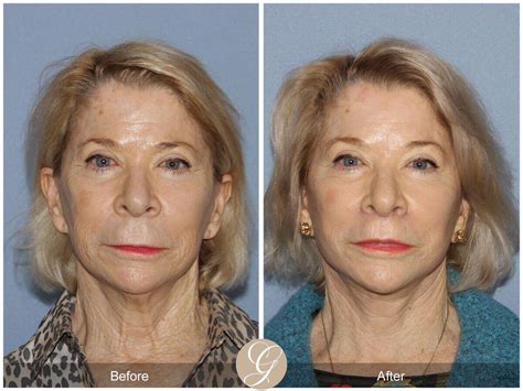 Lip Lift Before & After Photos From Dr. Kevin Sadati