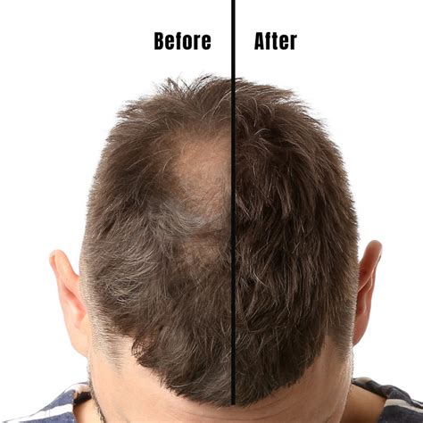 Results From Minoxidil: Before And After Pictures