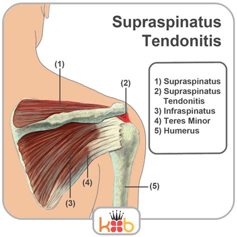 Shoulder Anatomy Supraspinatus Tendon Diagram Of Shoulder Tendons | Images and Photos finder